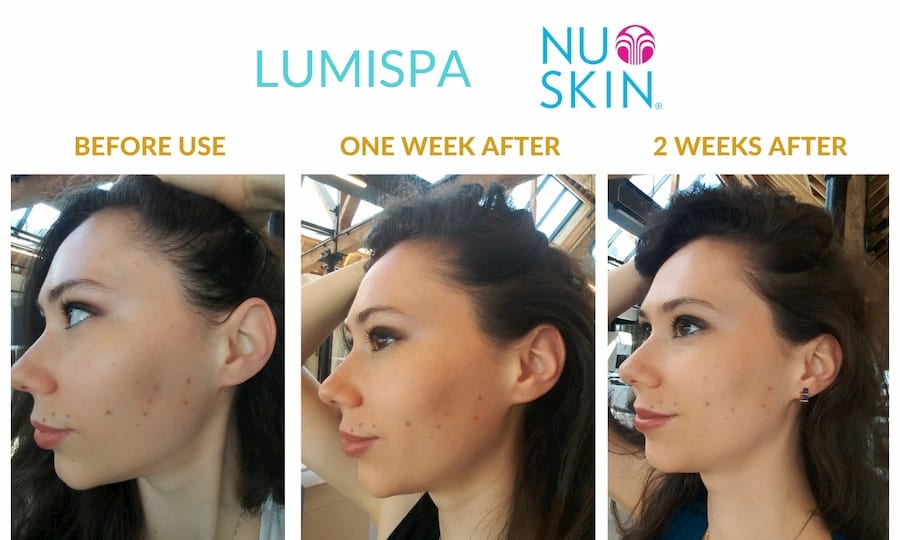 lumispa before and after wrinkles)