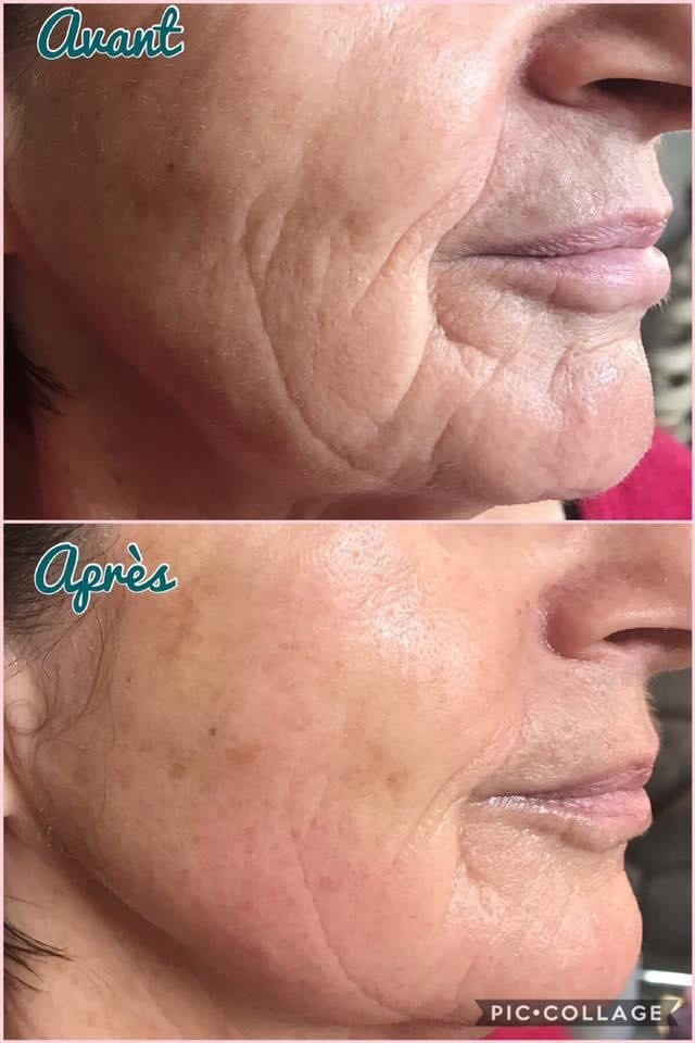 lumispa before and after wrinkles)